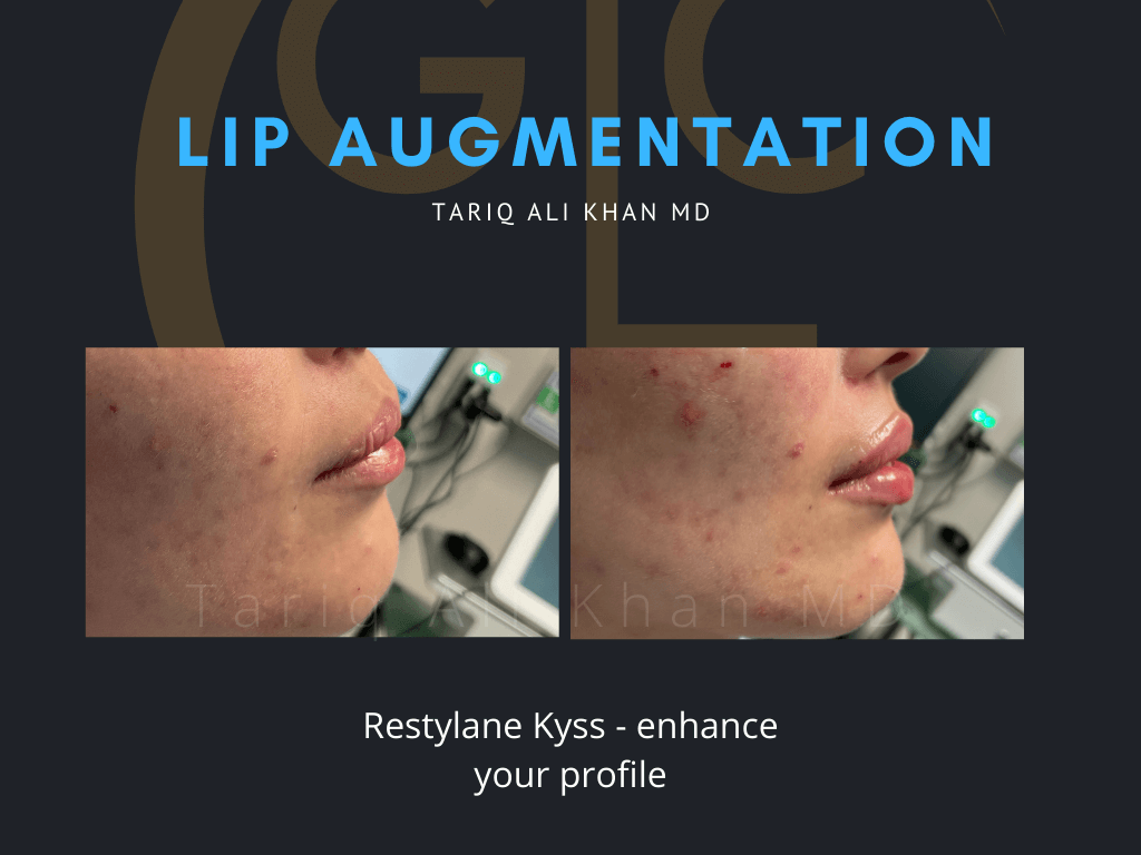 Gentle Care Laser Tustin Before and After picture - Lip Augmentation